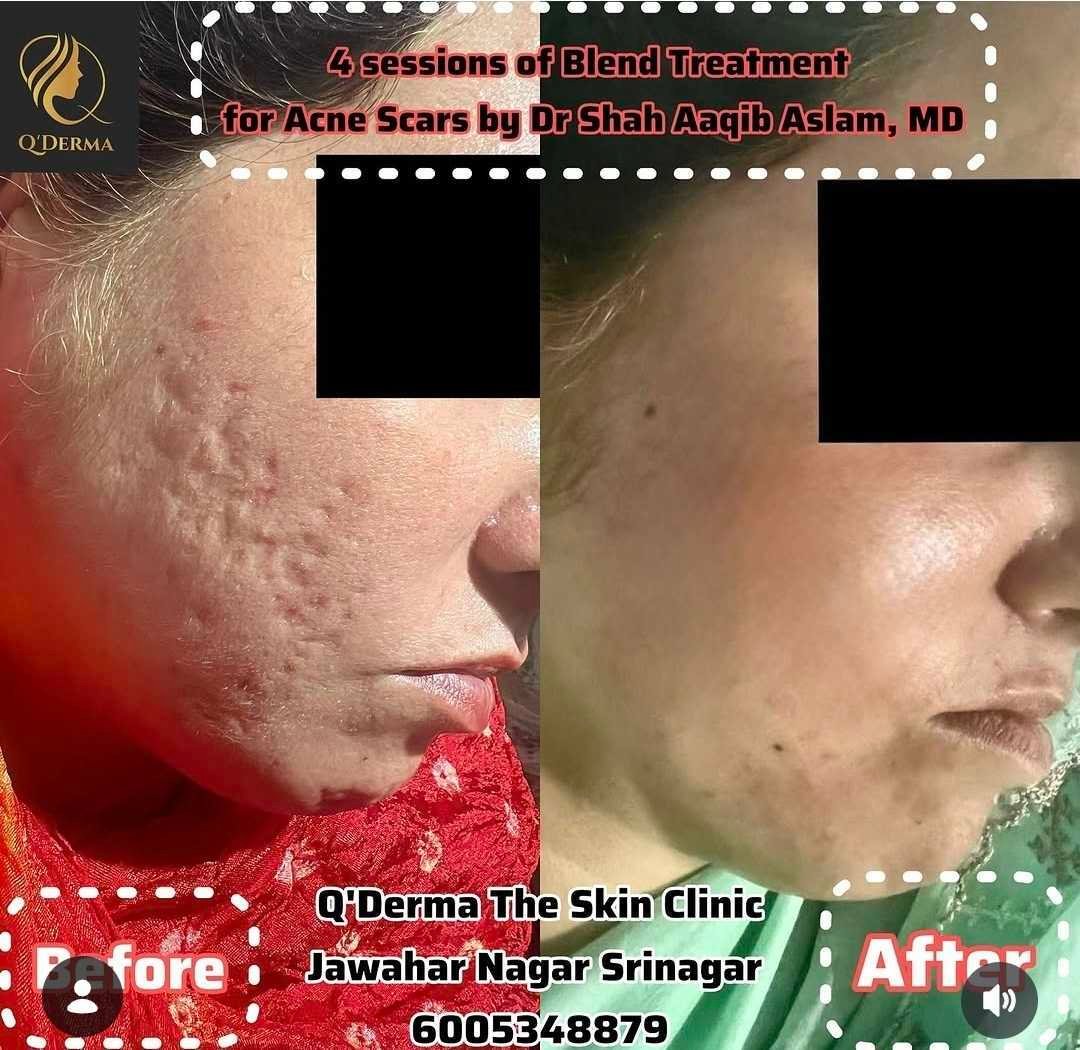Acne Scar Revision — before and after at Q'DERMA