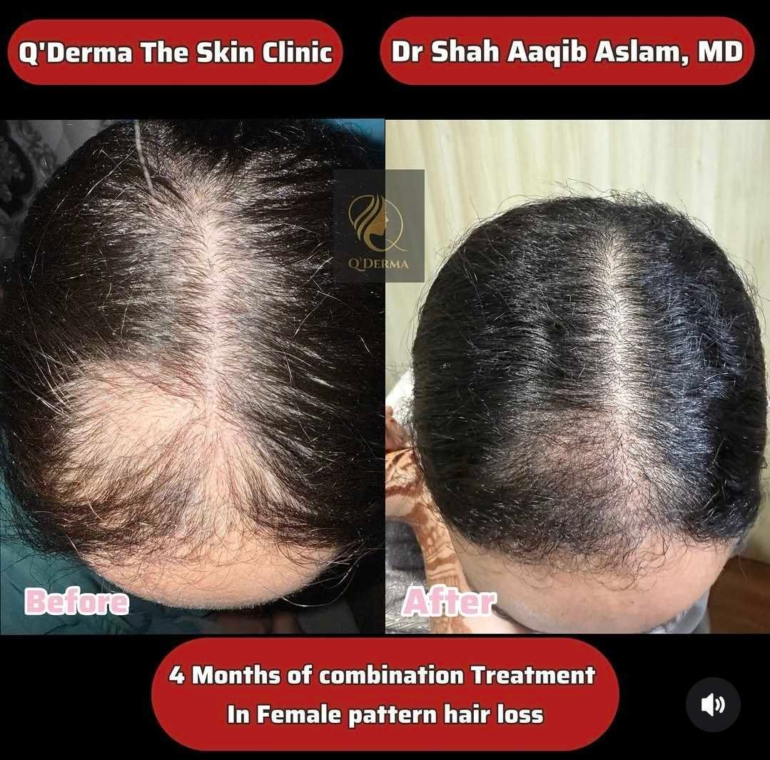 Female Pattern Hair Loss — before and after at Q'DERMA