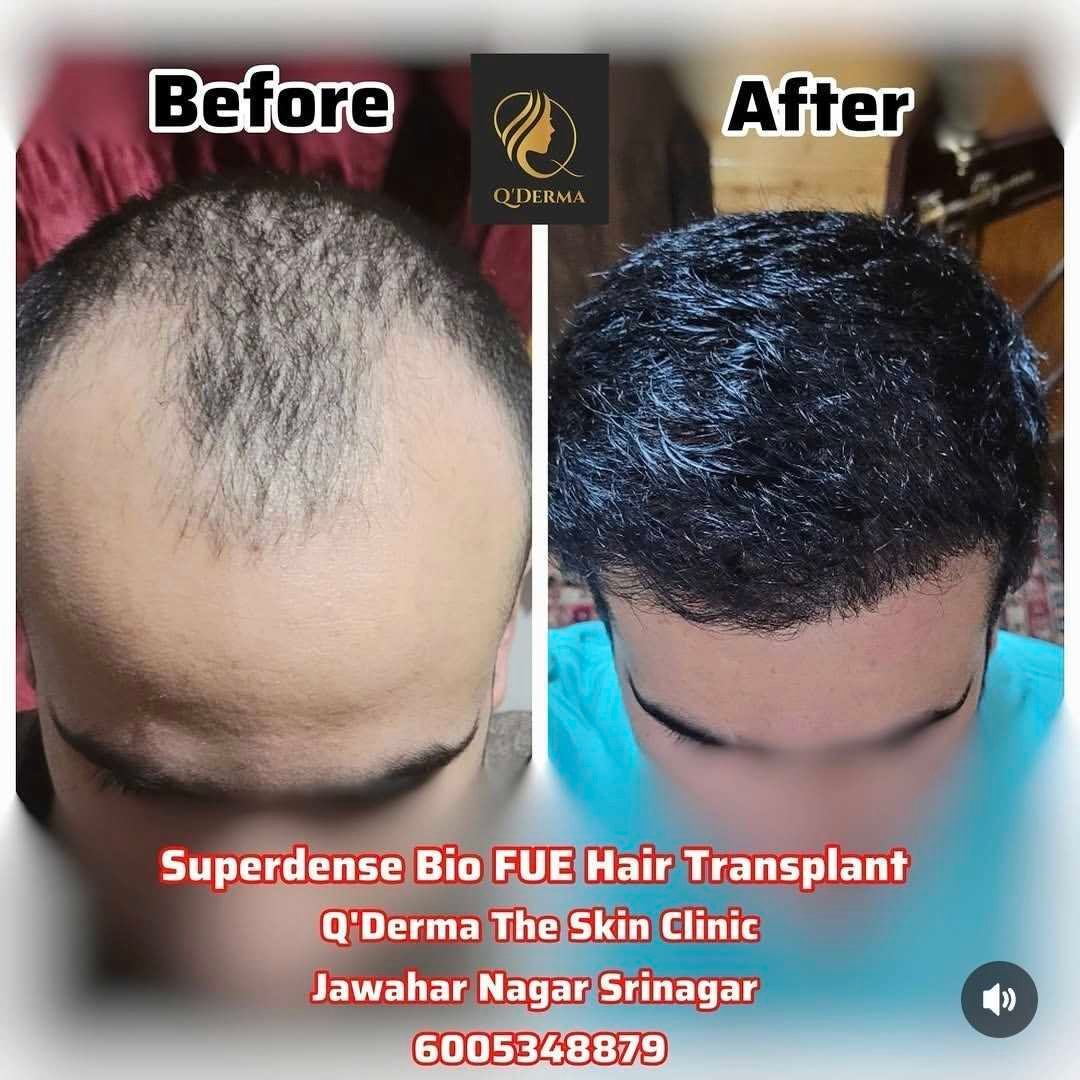 Hair Transplant — before and after at Q'DERMA