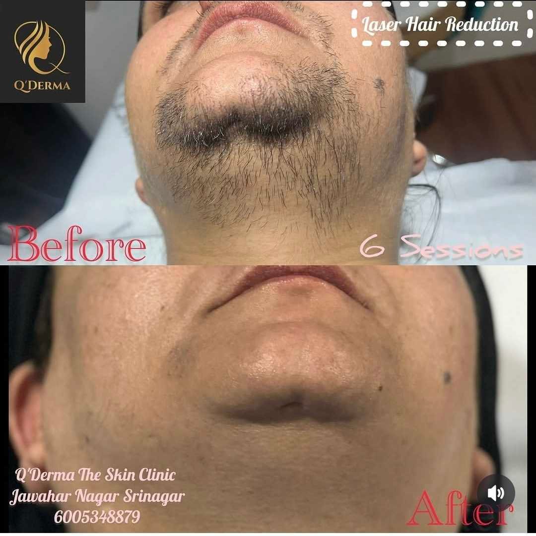 Laser Hair Reduction — before and after at Q'DERMA
