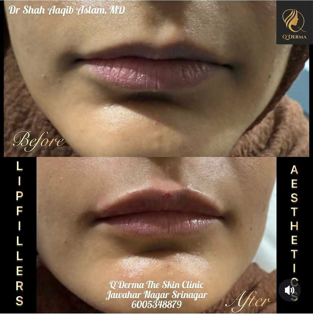 Lip Fillers — before and after at Q'DERMA